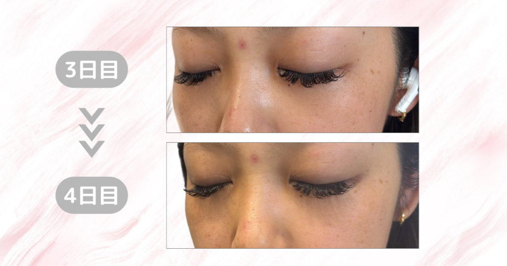 マジックティーツリーオイル検証｜4日目