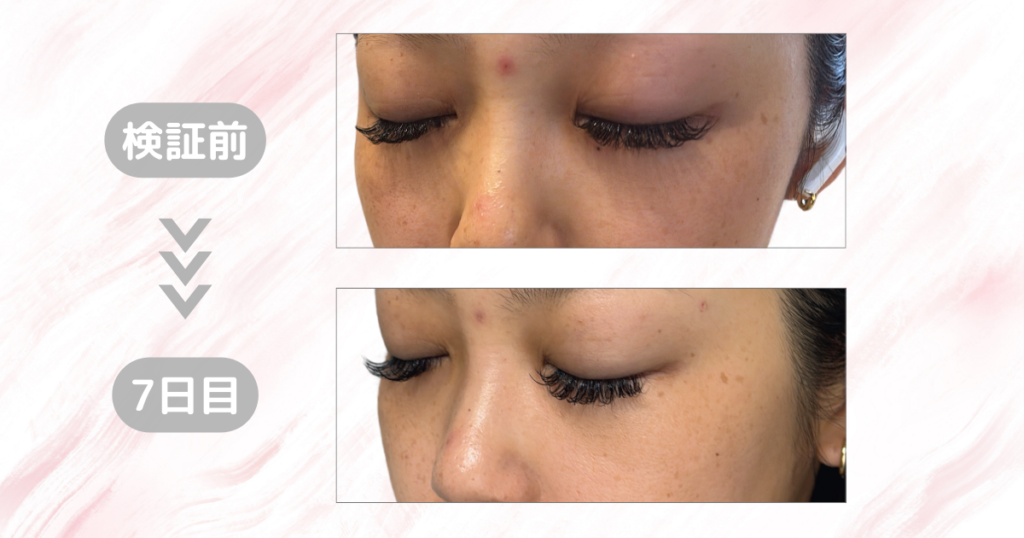 マジックティーツリーオイル検証｜初日から7日目