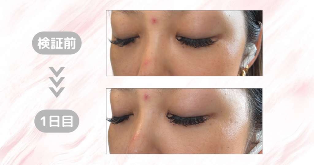 マジックティーツリーオイル検証｜1日目