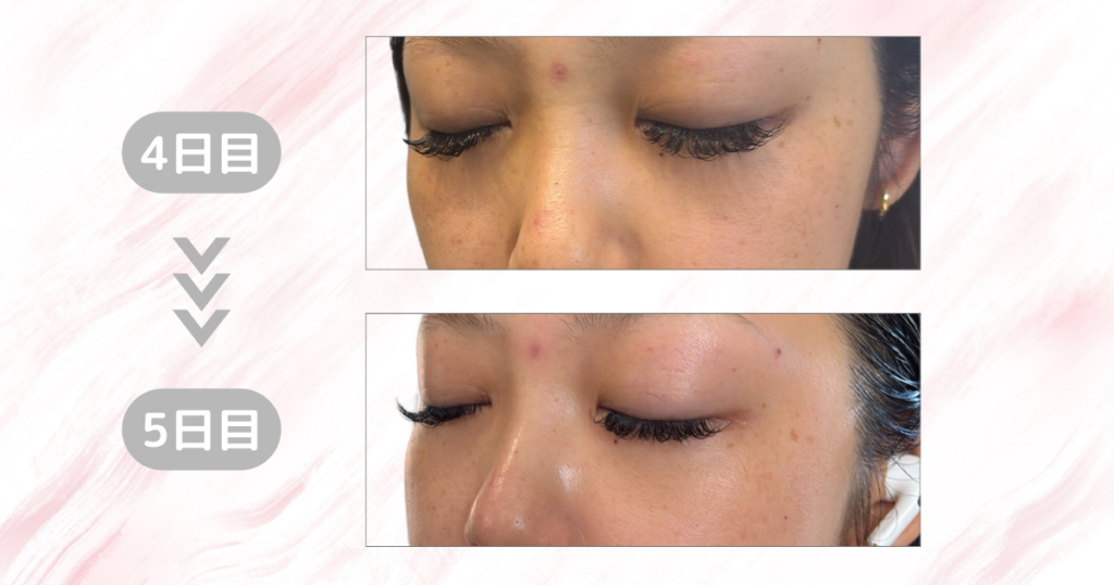 マジックティーツリーオイル検証｜5日目