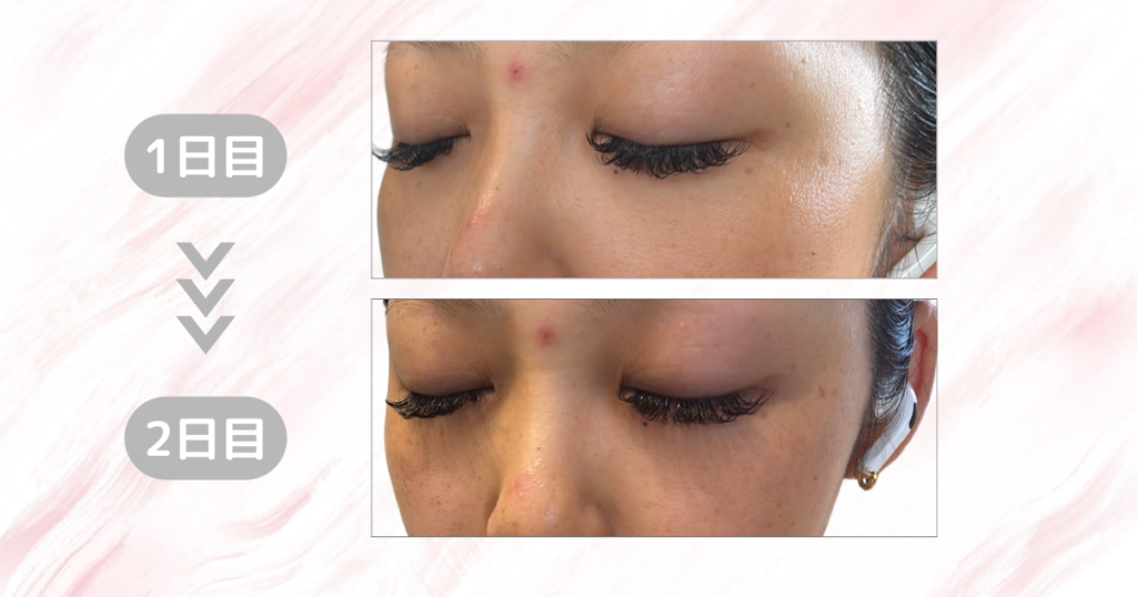 マジックティーツリーオイル検証｜2日目