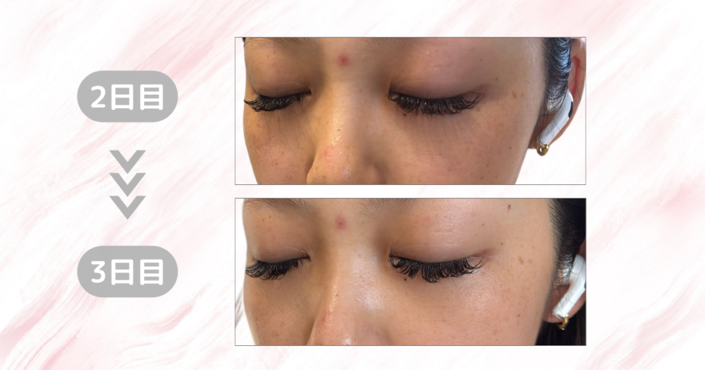 マジックティーツリーオイル検証｜3日目