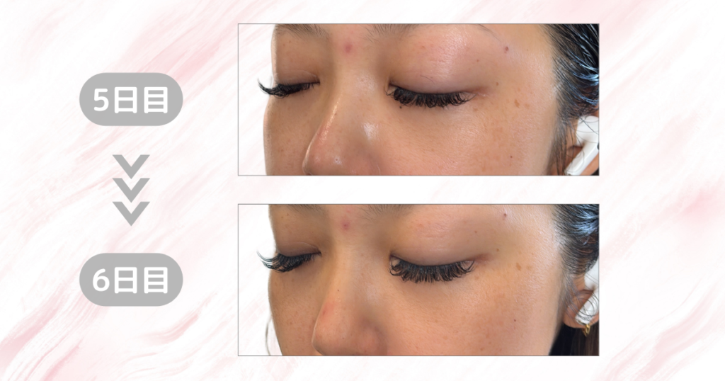 マジックティーツリーオイル検証｜6日目