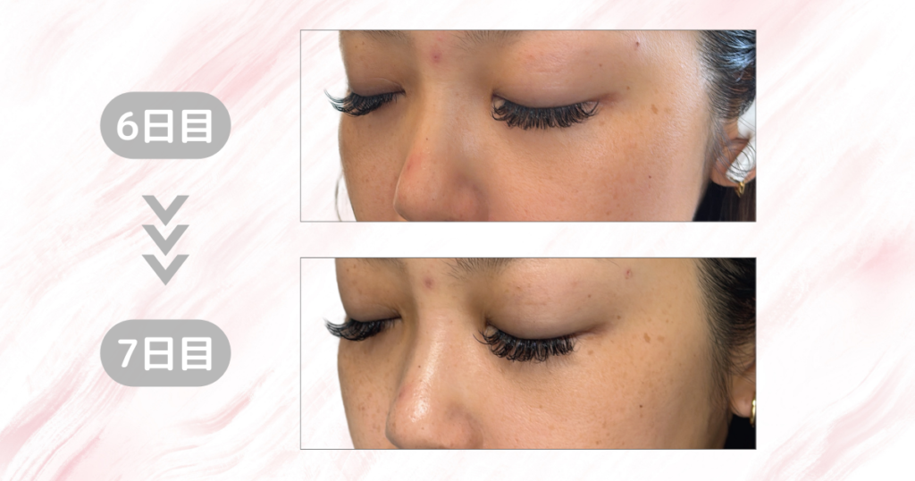 マジックティーツリーオイル検証｜7日目