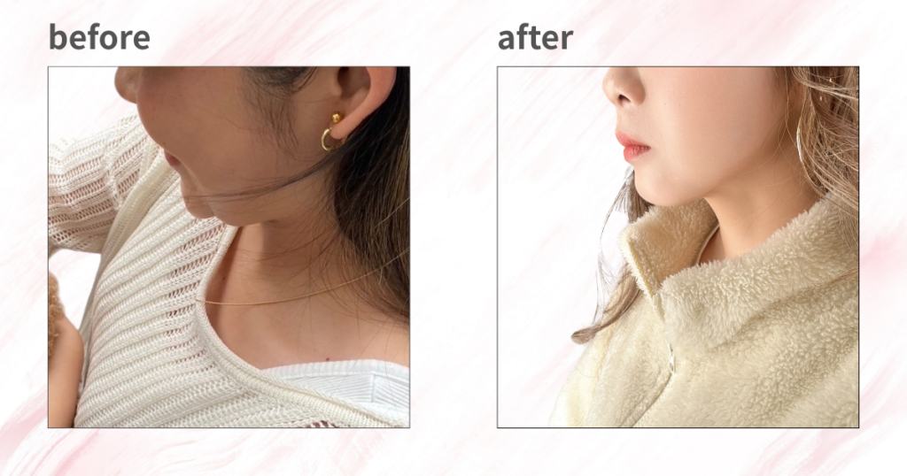 フェイスラインのマッサージをしたビフォーアフター